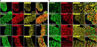 Loss of TROP2 and epithelial cell adhesion molecule expression is linked to grade progression in pTa but unrelated to disease outcome in pT2-4 urothelial bladder carcinomas